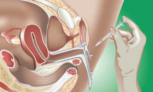 Sparsha Infertility Centre | Follicular Monitoring